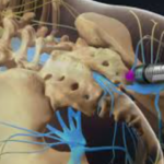 Epidural Treatment Lumber / Caudal